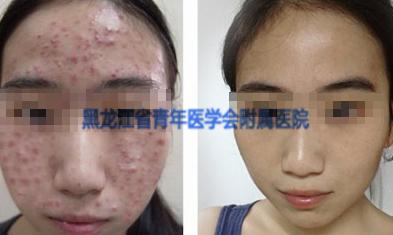 我院痤疮治疗前后对比图