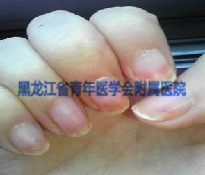 灰指甲的症状图（二）